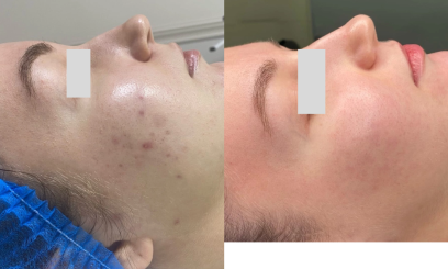 Авторский пилинг  от Пост-акне